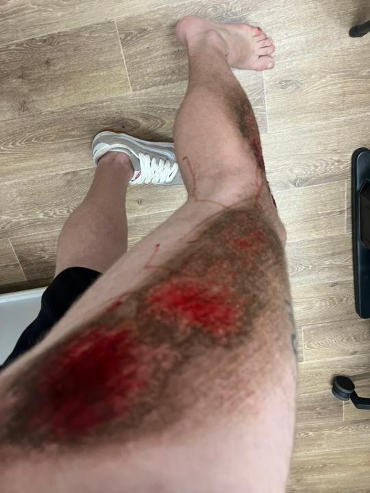 Foto 2 de 7 — Buraco na via provoca acidente e deixa motociclista com ferimentos graves em Araraquara